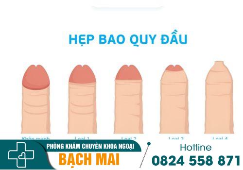 Bao quy đầu dài có nên cắt không? 3