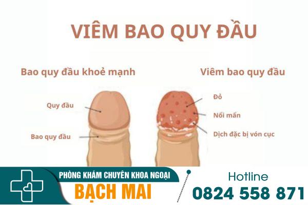 Viêm bao quy đầu và những điều mà nam giới cần biết 1